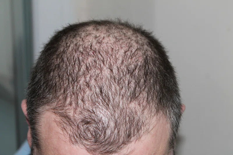 Can AGA(Androgenetic Alopecia) Be Improved With Saw Palmetto?